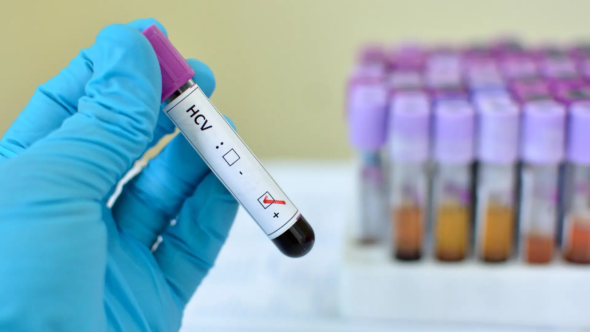 Anti-HCV